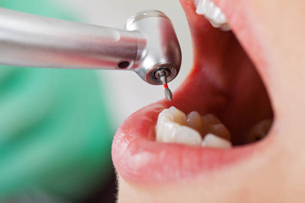 Best Emergency Dental Care for Broken or Chipped Teeth in New London, MN